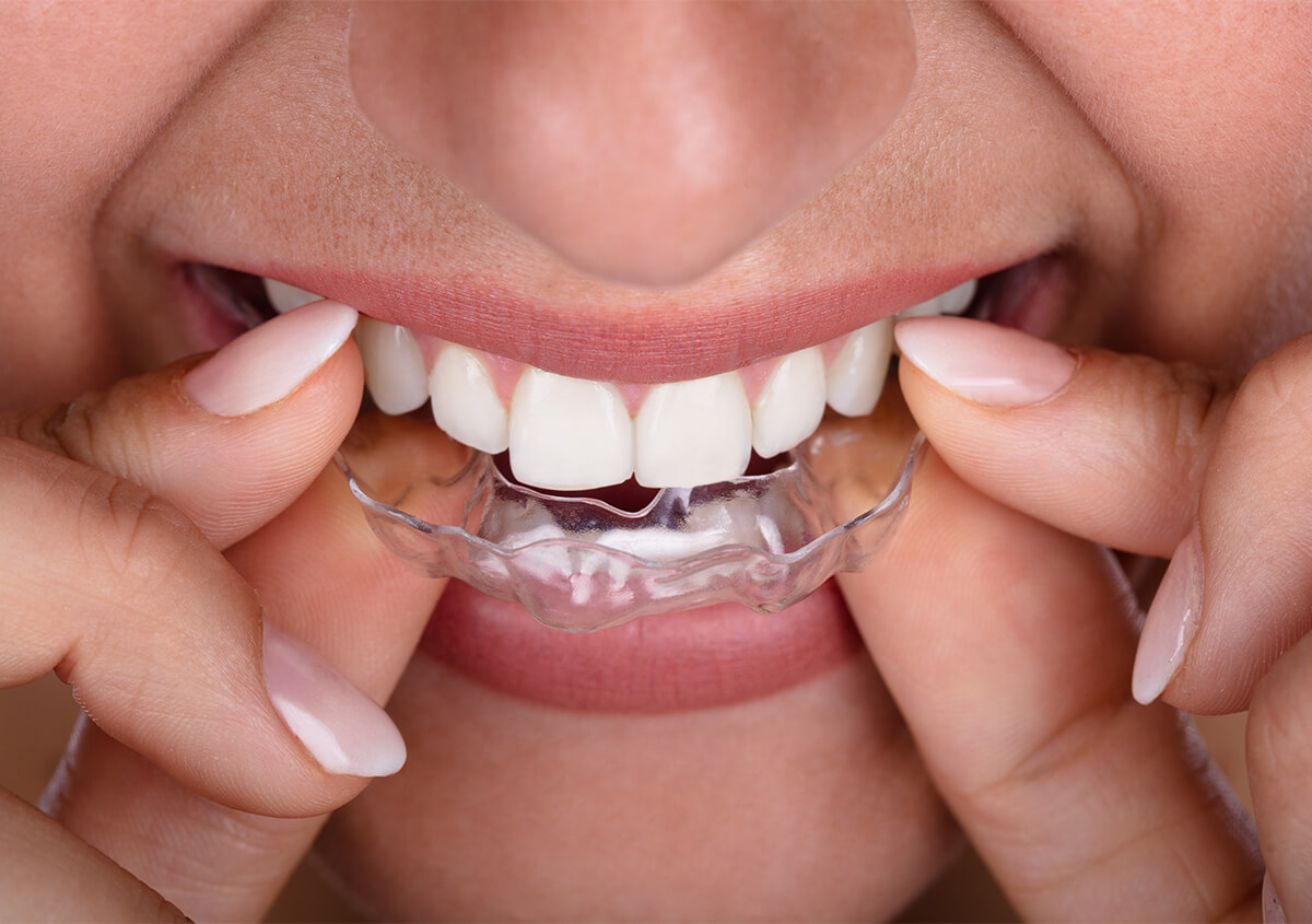 Invisalign for Adults in Brooklyn NY Area